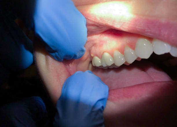 Best Emergency Dental Care for Broken or Chipped Teeth in Macungie, PA
